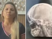 Mulher fica com bala alojada na cabeça após briga 