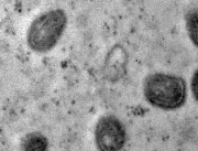 Uberlândia chega a 62 casos positivos de varíola d