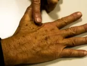 Novos casos de câncer de pele reduzem cerca de 32%
