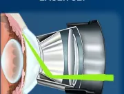 Laser SLT é utilizado no tratamento do glaucoma