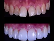Lentes de contato dental podem ser aplicadas em re
