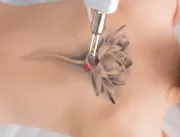 Remoção de tatuagens cresce e evolui suas técnicas