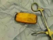 Homem faz cirurgia após passar seis meses com celu