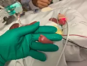Bebê que nasceu com 335 gramas deixa hospital após