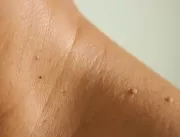 O que são as bolinhas que aparecem na pele conform