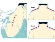 Botox é aplicado no trapézio para imitar pescoço f