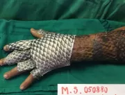 Brasileiros testam pele de tilápia como tratamento