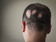 Manual da alopecia areata: tudo sobre a doença aut