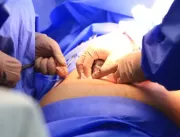 Cinco estados podem zerar fila de cirurgias no SUS