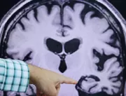 Alzheimer foi transmitido entre humanos em procedi