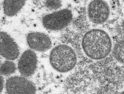 Turista italiano morre vítima da varíola dos macac