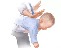 Técnica para desengasgar bebê de influenciadora nã