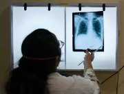 Casos de tuberculose aumentam devido à pandemia de