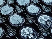 Cientista sueco por trás de droga para Alzheimer t