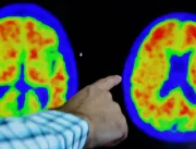 Cientistas descobrem que há 5 tipos da doença de Alzheimer