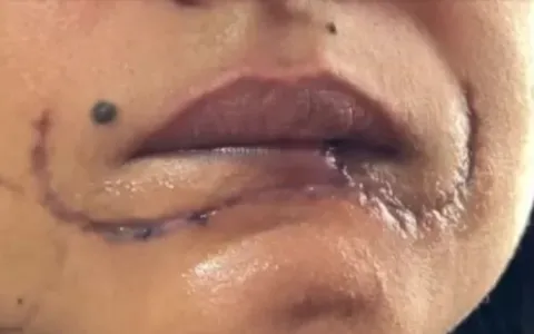 Homem arranca lábio de ex-companheira com mordida 
