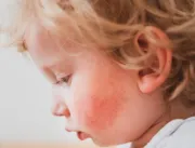 Alergia alimentar mais comum em bebês de até um an