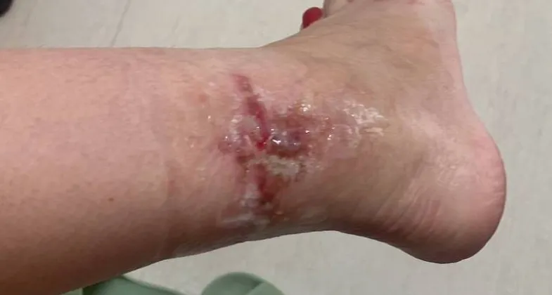 Senti minha pele sendo queimada viva, diz paciente que fez spa dos pés