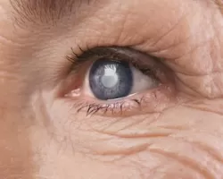 Quase 70% dos brasileiros com glaucoma desconhecem