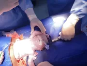 Bebê é operado  ainda ligado à mãe por cordão umbi