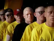 Assassinatos de albinos cresceram na pandemia, rev