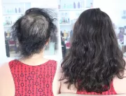 Alopecia e autoestima: entenda como o mega hair po