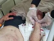 Fotos de homem ferido após mordidas de pit-bull mo