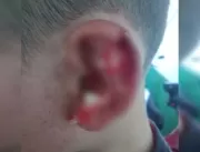 Aluno autista tem pedaço da orelha arrancado duran