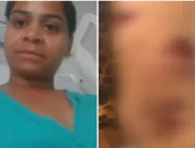 Mulher atacada por três pit bulls em Goianira deix