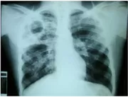 Distrito Federal registra 285 casos de tuberculose