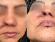 Dentista é indiciado após paciente perder parte do nariz depois de cirurgia estética