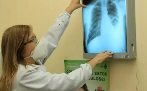 Casos de tuberculose crescem mais de 30% em Uberlâ