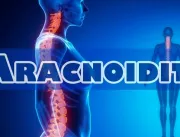 Aracnoidite: uma doença grave e dolorida