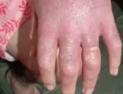 Homem sofre queimaduras após preparar caipirinhas 
