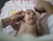 Casos confirmados de microcefalia no Brasil chegam