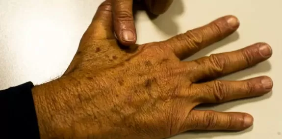 Novos casos de câncer de pele reduzem cerca de 32%