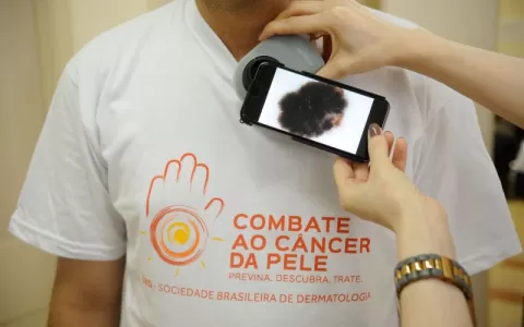 Câncer de Pele: mutirão realiza diagnóstico precoc