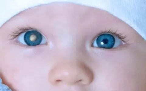 ​Câncer no olho do bebê pode passar despercebido
