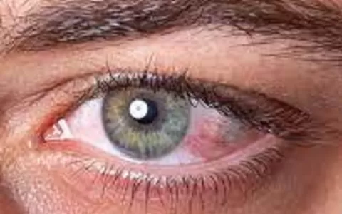 ​Olho seco e visão embaçada podem ser sintomas da 