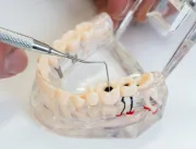 Canal no dente, especialista explica o passo a pas