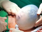 Muito raro: parto de gêmeas tem uma bebê empelicad