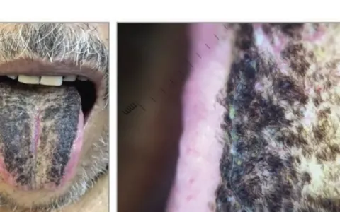Homem apresenta língua preta peluda três meses apó