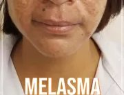 Melasma pode ser tratado com ativos específicos