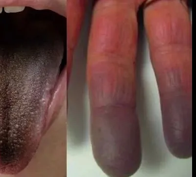 Língua peluda e dedo roxo: saiba mais sobre os nov