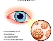 Infecções oculares por Herpes Simples têm tratamen