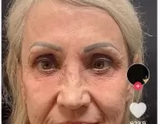 Mulher ‘troca de rosto’ após procedimento estético