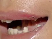 Travesti de 15 anos tem dentes quebrados após ser atacada e agredida em via pública