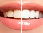 ​“Mitos e Verdades” do clareamento dental