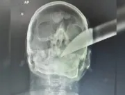 Raio-X mostra facão cravado na cabeça de homem apó