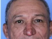 Homem que tinha pênis no nariz celebra cirurgia: P